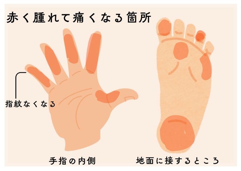 手足症候群で腫れる箇所