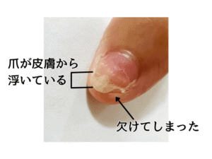 浮いている爪の画像