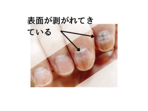 表面の剥がれた爪の画像